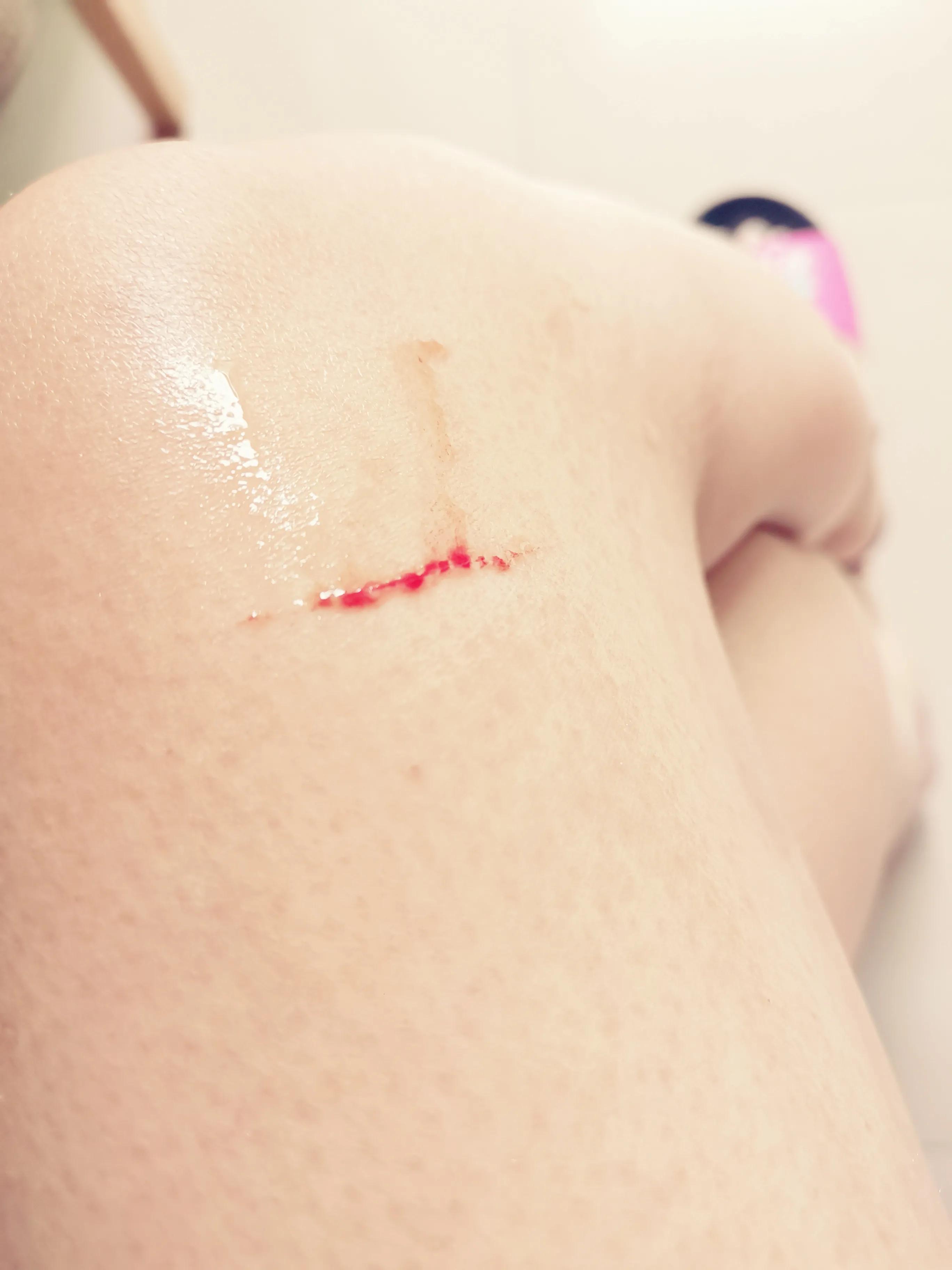 被没打疫苗的小猫抓伤出血要打针吗，被猫咪抓伤要打狂犬疫苗吗